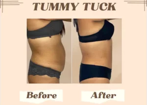 Is A Tummy Tuck Worth It : Yay Or Nay